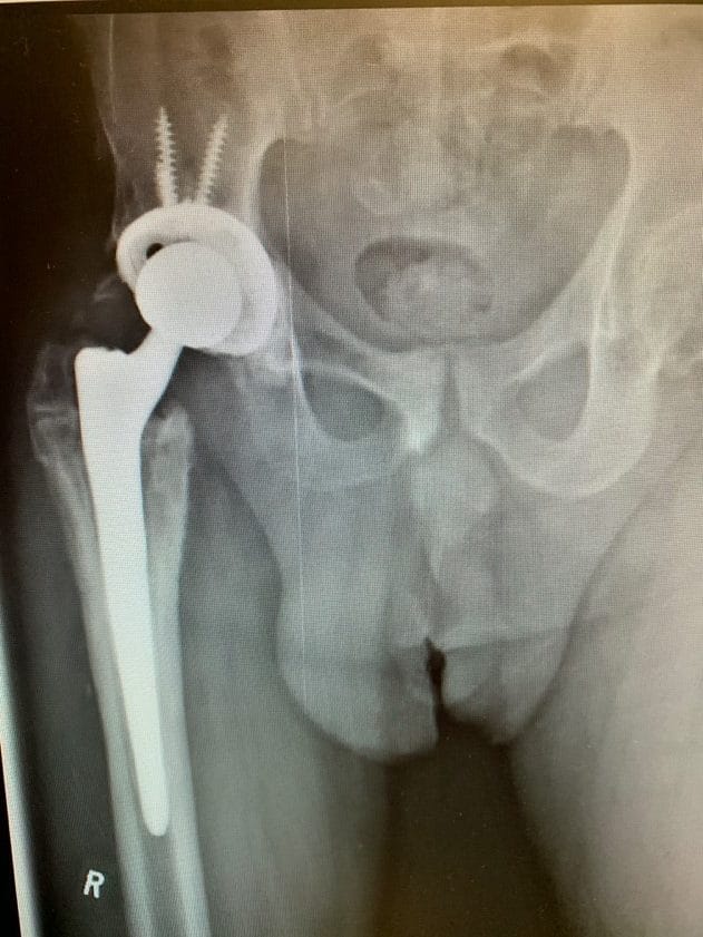 Complex Hip replacement – Implant removal with total hip replacement