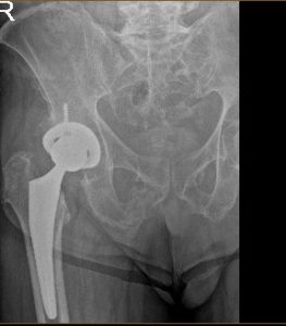 Xray of a hip replacement Xray of a hip replacement
