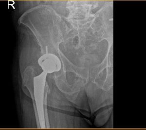 Post op hip Xray Post op hip Xray