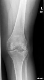 X-ray showing AP and Lateral views of the left knee post removal of the lateral plateau plate X-ray showing AP and Lateral views of the left knee post removal of the lateral plateau plate