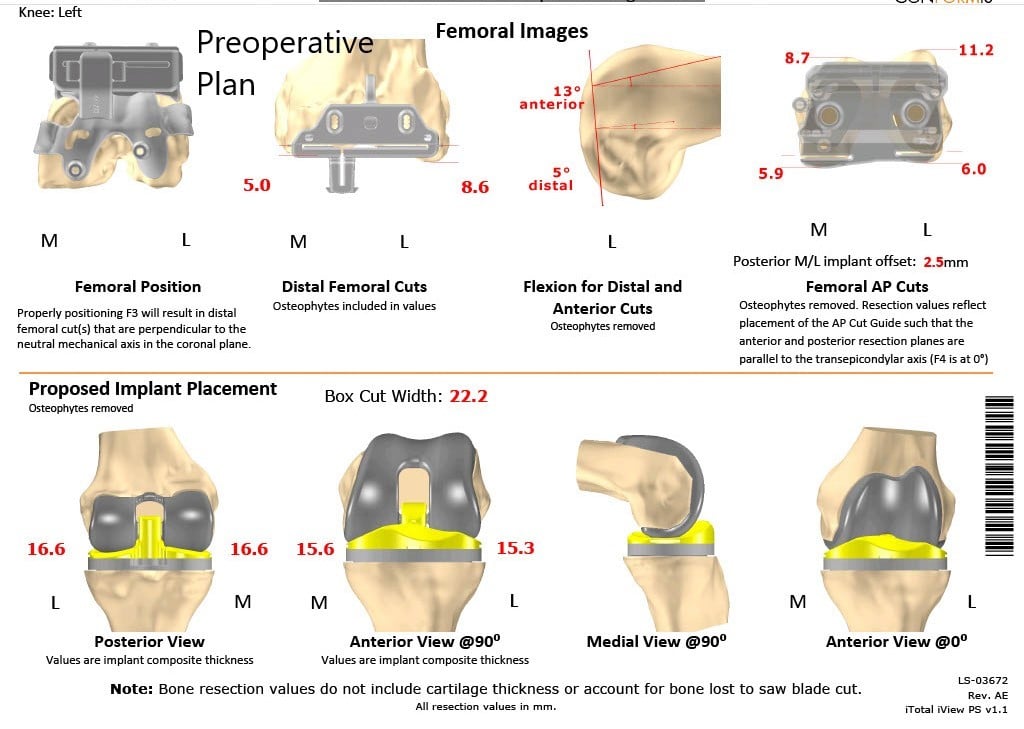 A patient specific surgical plan for a patient at Complete Orthopedics in New York - scan 4 A patient specific surgical plan for a patient at Complete Orthopedics in New York - scan 4