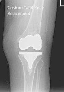 Postoperative X-ray showing AP and lateral views of the right and the left knee joint