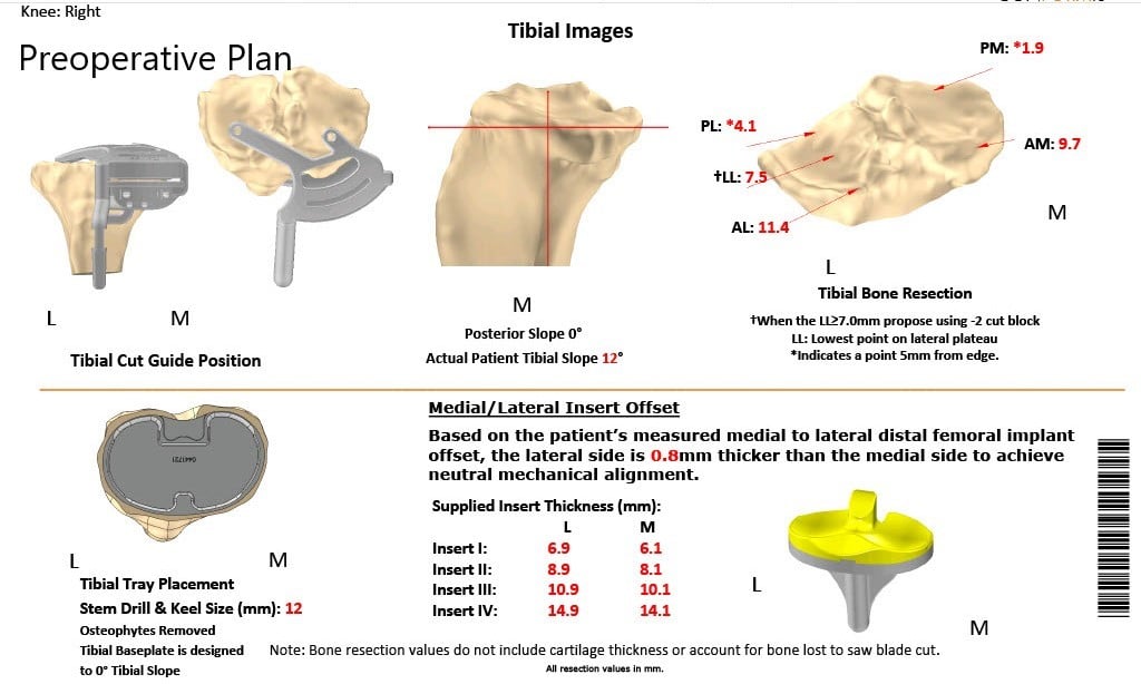 A patient specific surgical plan for a patient at Complete Orthopedics in New York A patient specific surgical plan for a patient at Complete Orthopedics in New York