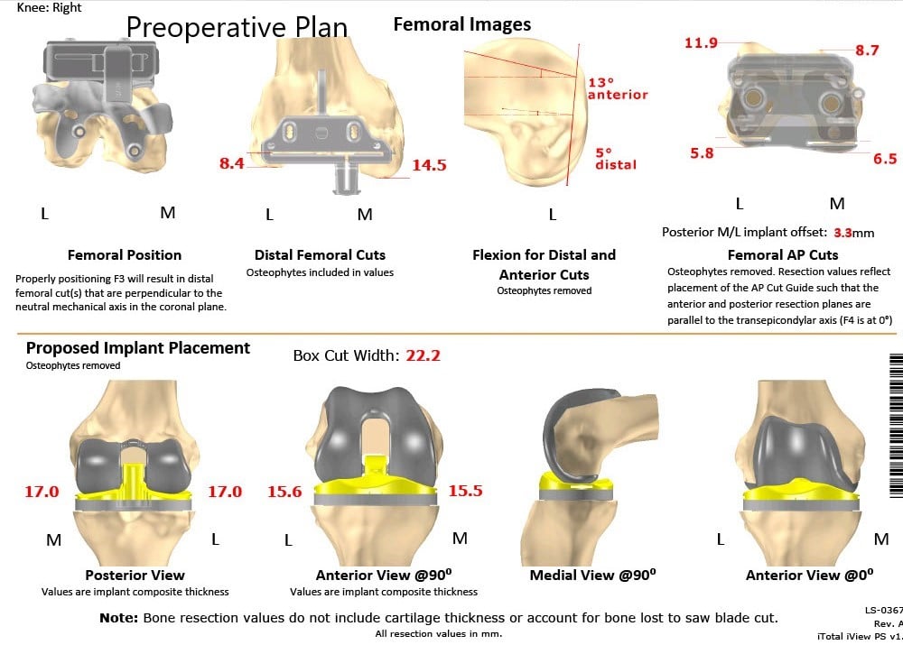 A patient specific surgical plan for a patient at Complete Orthopedics in New York - scan 2 A patient specific surgical plan for a patient at Complete Orthopedics in New York - scan 2