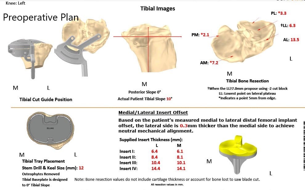 A patient specific surgical plan for a patient at Complete Orthopedics in New York - scan 3 A patient specific surgical plan for a patient at Complete Orthopedics in New York - scan 3