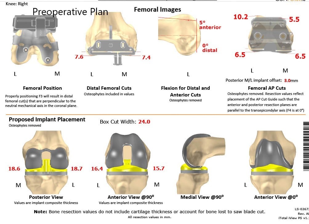 Complete Orthopedics patient specific surgical plan for a Custom Unilateral Knee Replacement in a 74-year-old Female - scan 2 Complete Orthopedics patient specific surgical plan for a Custom Unilateral Knee Replacement in a 74-year-old Female - scan 2