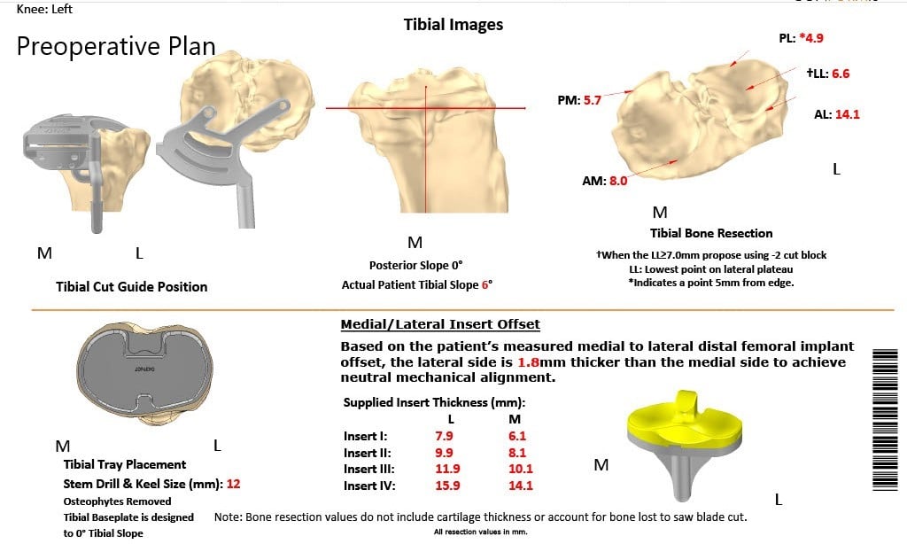Complete Orthopedics patient specific surgical plan for a Customized Left Knee Replacement in an 81-year-old patient Complete Orthopedics patient specific surgical plan for a Customized Left Knee Replacement in an 81-year-old patient