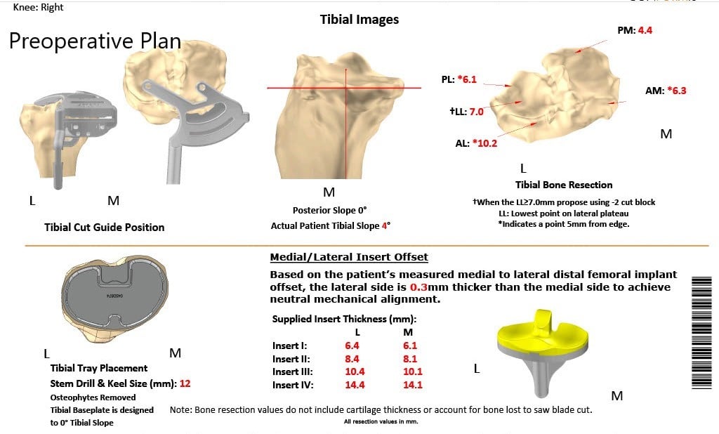 Complete Orthopedics patient specific surgical plan for a Customized Right Knee Replacement in a 71-year-old patient Complete Orthopedics patient specific surgical plan for a Customized Right Knee Replacement in a 71-year-old patient