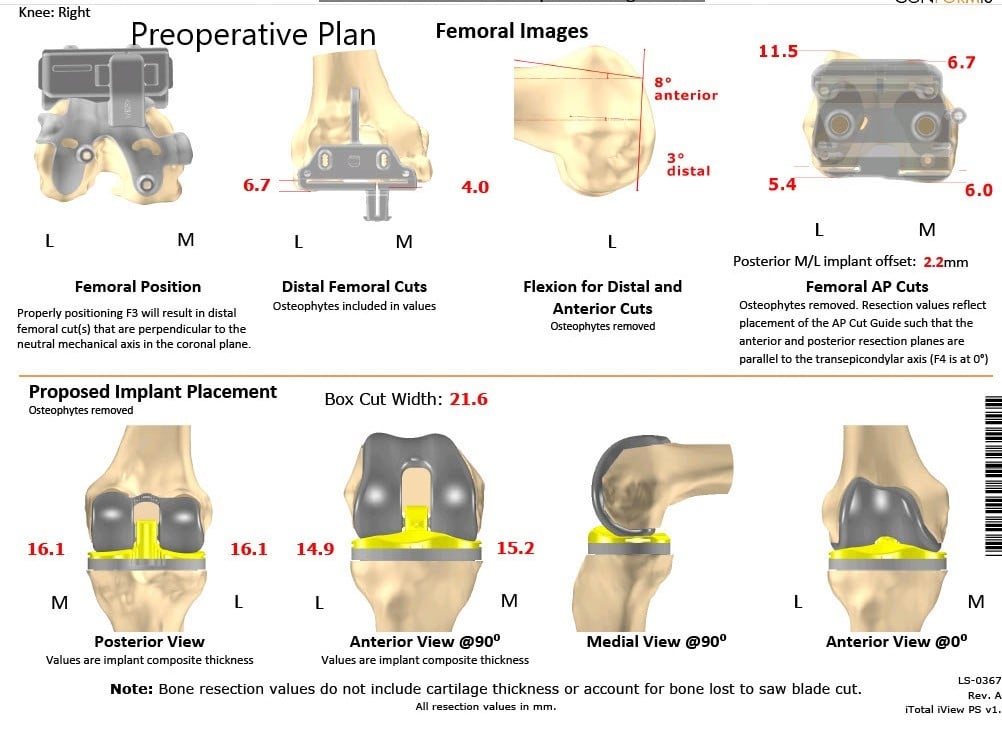Complete Orthopedics patient specific surgical plan for a Customized Right Knee Replacement in a 71-year-old patient - scan 2 Complete Orthopedics patient specific surgical plan for a Customized Right Knee Replacement in a 71-year-old patient - scan 2