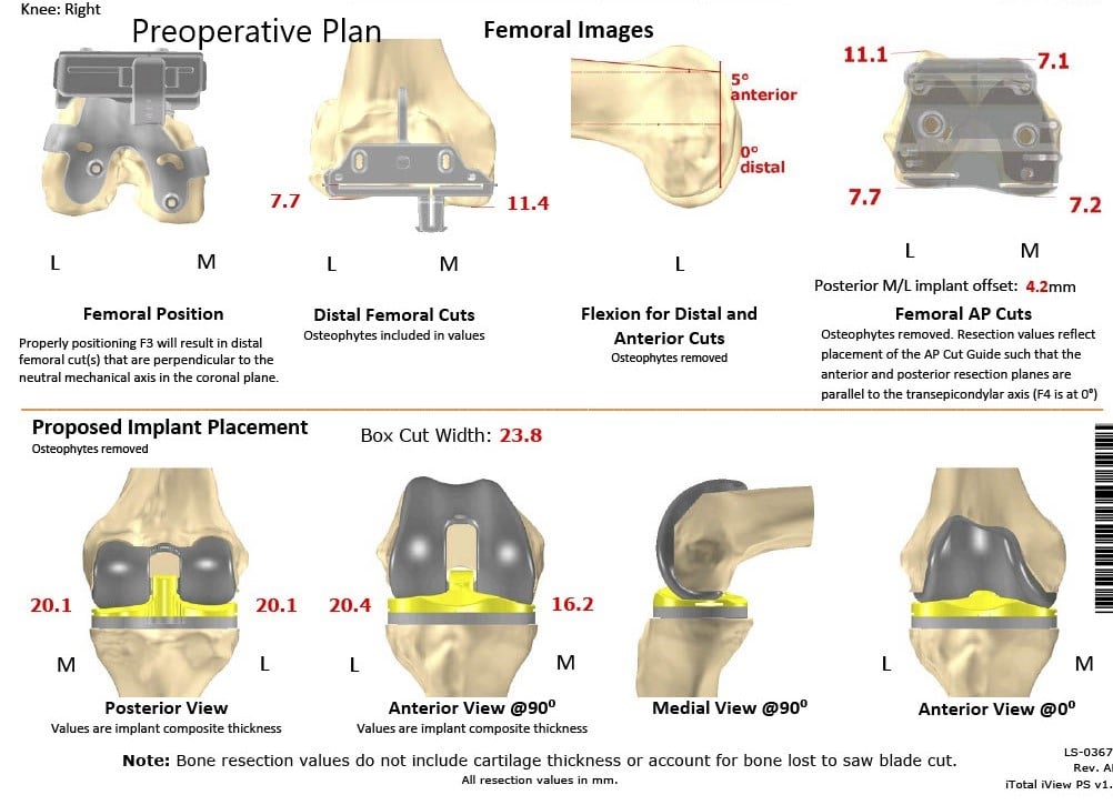 Complete Orthopedics patient specific surgical plan for a Customized Total Knee Replacement in a 58-year-old female with Arthritis - scan 2 Complete Orthopedics patient specific surgical plan for a Customized Total Knee Replacement in a 58-year-old female with Arthritis - scan 2