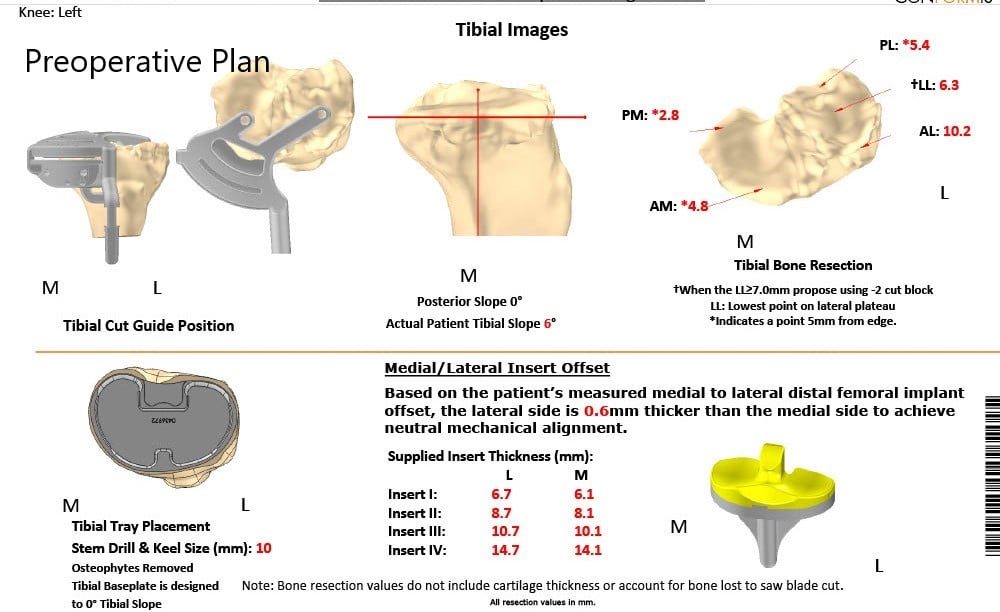 Complete Orthopedics patient specific surgical plan for Customized Total Knee Replacement in a 59-year-old male Complete Orthopedics patient specific surgical plan for Customized Total Knee Replacement in a 59-year-old male