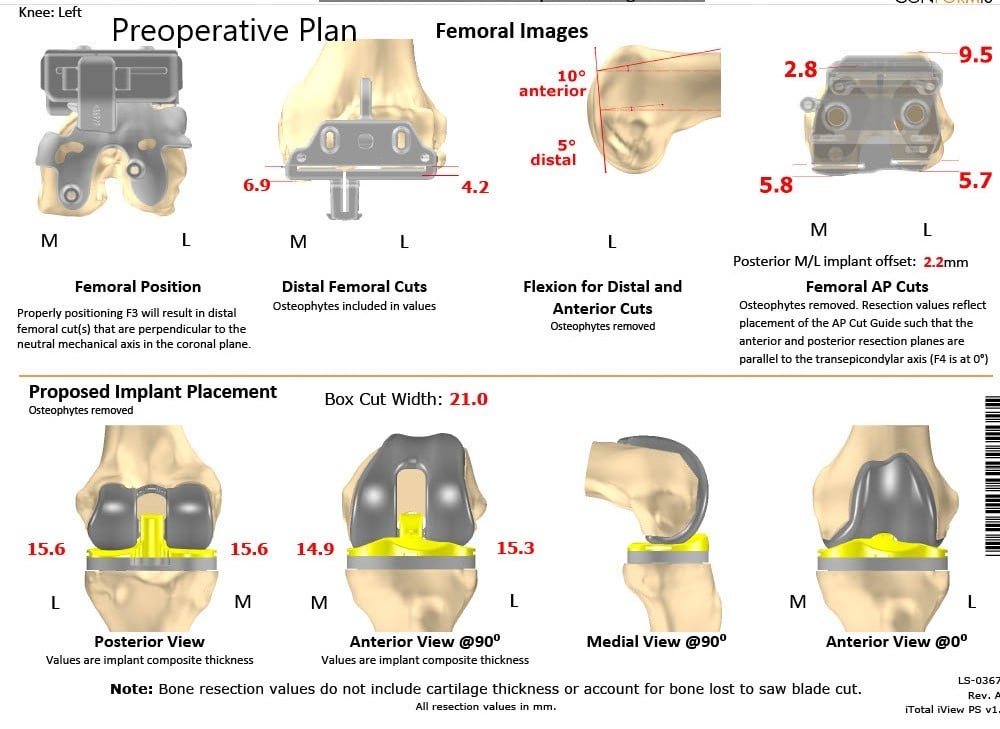 Complete Orthopedics patient specific surgical plan for Customized Total Knee Replacement in a 59-year-old male - scan 2 Complete Orthopedics patient specific surgical plan for Customized Total Knee Replacement in a 59-year-old male - scan 2