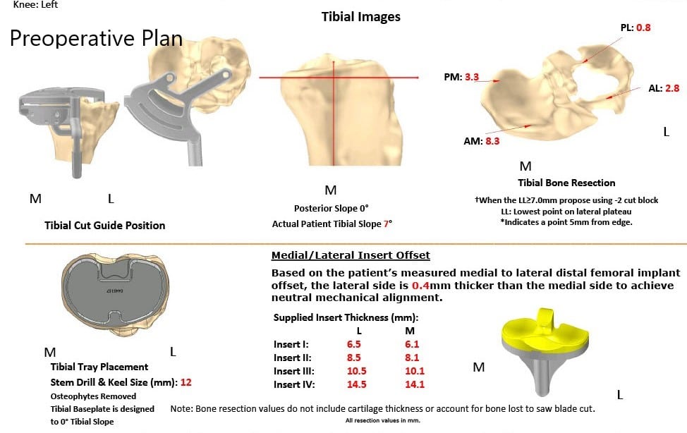 Complete Orthopedics patient specific surgical plan for a Complete Orthopedics patient specific surgical plan for a Custom Total Knee Replacement in Left Knee Arthritis with prior Hardware on the Lateral Tibial Plateau Complete Orthopedics patient specific surgical plan for a Custom Total Knee Replacement in Left Knee Arthritis with prior Hardware on the Lateral Tibial Plateau