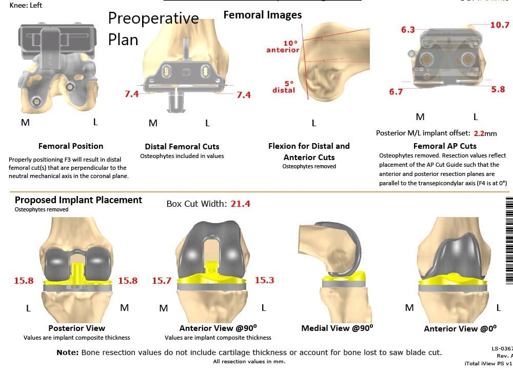 Complete Orthopedics patient specific surgical plan for a Custom Total Knee Replacement in Left Knee Arthritis with prior Hardware on the Lateral Tibial Plateau - scan 2 Complete Orthopedics patient specific surgical plan for a Custom Total Knee Replacement in Left Knee Arthritis with prior Hardware on the Lateral Tibial Plateau - scan 2