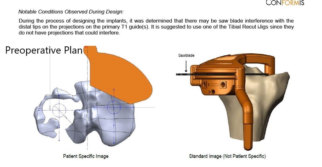 Complete Orthopedics patient specific surgical plan for a Custom Total Knee Replacement in Left Knee Arthritis with prior Hardware on the Lateral Tibial Plateau - scan 4 Complete Orthopedics patient specific surgical plan for a Custom Total Knee Replacement in Left Knee Arthritis with prior Hardware on the Lateral Tibial Plateau - scan 4