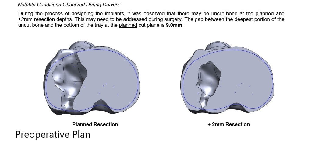 Complete Orthopedics patient specific surgical plan for a Custom Total Knee Replacement in Left Knee Arthritis with prior Hardware on the Lateral Tibial Plateau - scan 3 Complete Orthopedics patient specific surgical plan for a Custom Total Knee Replacement in Left Knee Arthritis with prior Hardware on the Lateral Tibial Plateau - scan 3
