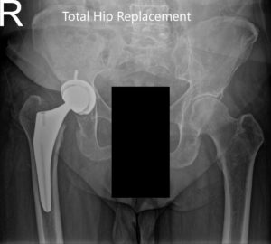 Postoperative X-ray showing the AP view of the pelvis and the frog-legged lateral view of the right hip - img 2 Postoperative X-ray showing the AP view of the pelvis and the frog-legged lateral view of the right hip - img 2