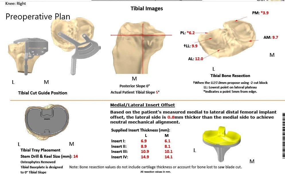 Complete Orthopedics patient specific surgical plan for a Left Custom Total Knee Arthroplasty in a 68-year-old male Complete Orthopedics patient specific surgical plan for a Left Custom Total Knee Arthroplasty in a 68-year-old male