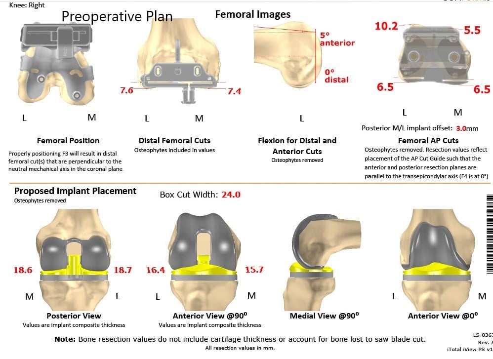 Complete Orthopedics patient specific surgical plan for a Left Custom Total Knee Arthroplasty in a 68-year-old male - scan 2 Complete Orthopedics patient specific surgical plan for a Left Custom Total Knee Arthroplasty in a 68-year-old male - scan 2