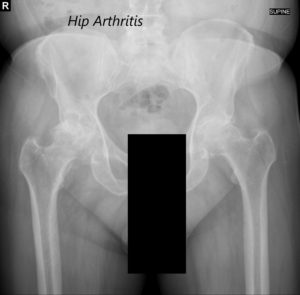 AP view of the Pelvis X ray showing both hip joints with frog leg lateral views of the right and left hip joints suggesting severe bilateral osteoarthritis of the hip joints