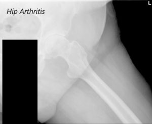 AP view of the Pelvis X ray showing both hip joints with frog leg lateral views of the right and left hip joints suggesting severe bilateral osteoarthritis of the hip joints - img 3
