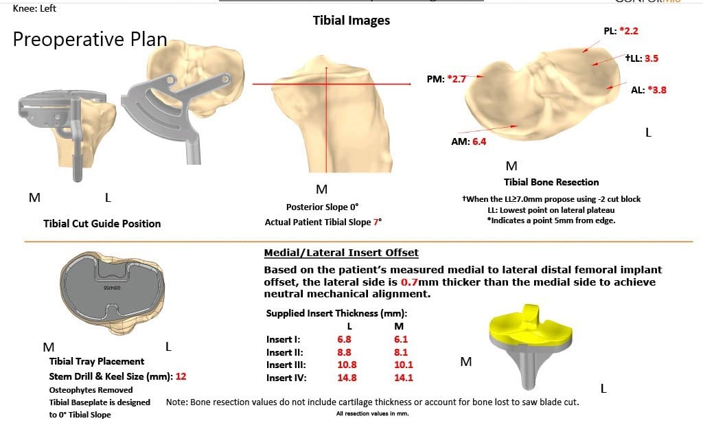 Complete Orthopedics patient specific surgical plan for a Custom Left Knee Replacement for Post-traumatic Arthritis in a 45-year-old Male Complete Orthopedics patient specific surgical plan for a Custom Left Knee Replacement for Post-traumatic Arthritis in a 45-year-old Male