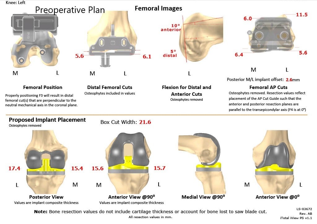 Complete Orthopedics patient specific surgical plan for a Custom Left Knee Replacement for Post-traumatic Arthritis in a 45-year-old Male - scan 2 Complete Orthopedics patient specific surgical plan for a Custom Left Knee Replacement for Post-traumatic Arthritis in a 45-year-old Male - scan 2