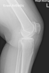 Preoperative X-ray of the left knee showing AP and lateral views