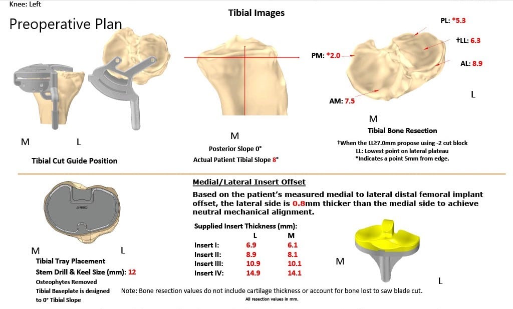 Complete Orthopedics patient specific surgical plan for a Custom Left Knee Replacement in a 40 year male Complete Orthopedics patient specific surgical plan for a Custom Left Knee Replacement in a 40 year male