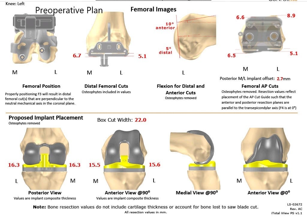Complete Orthopedics patient specific surgical plan for a Custom Left Knee Replacement in a 40 year male - scan 2 Complete Orthopedics patient specific surgical plan for a Custom Left Knee Replacement in a 40 year male - scan 2