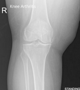 Pre-Operative AP and Lateral X-Ray views of the right knee (standing)