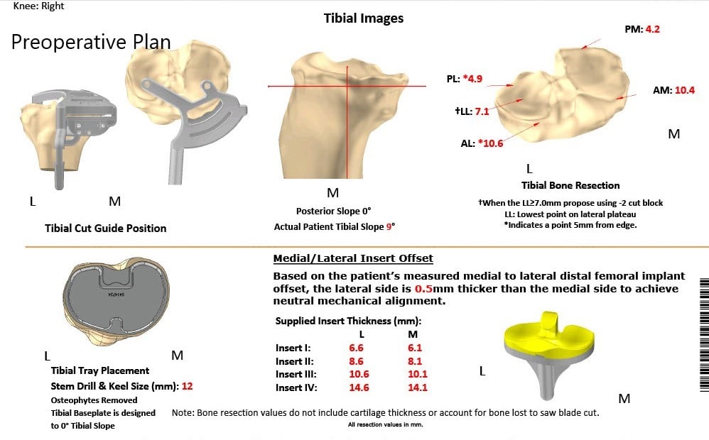 Complete Orthopedics patient specific surgical plan for a Custom Right Total Knee Arthroplasty - 62-year-old male Complete Orthopedics patient specific surgical plan for a Custom Right Total Knee Arthroplasty - 62-year-old male