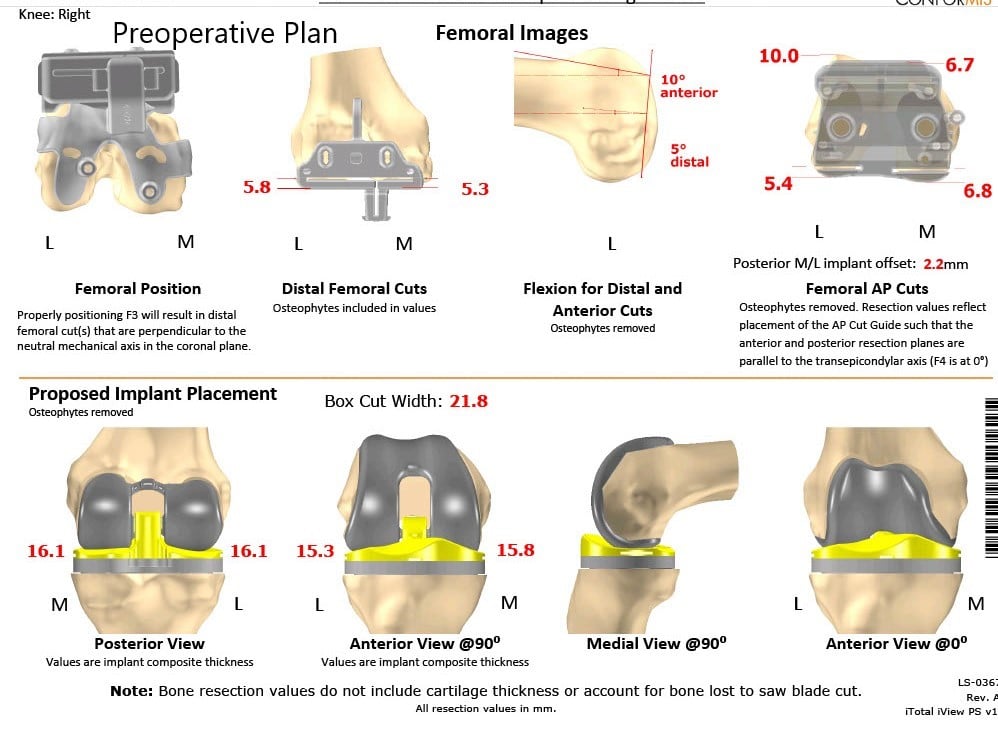 Complete Orthopedics patient specific surgical plan for a Custom Right Total Knee Arthroplasty - 62-year-old male - scan 2 Complete Orthopedics patient specific surgical plan for a Custom Right Total Knee Arthroplasty - 62-year-old male - scan 2