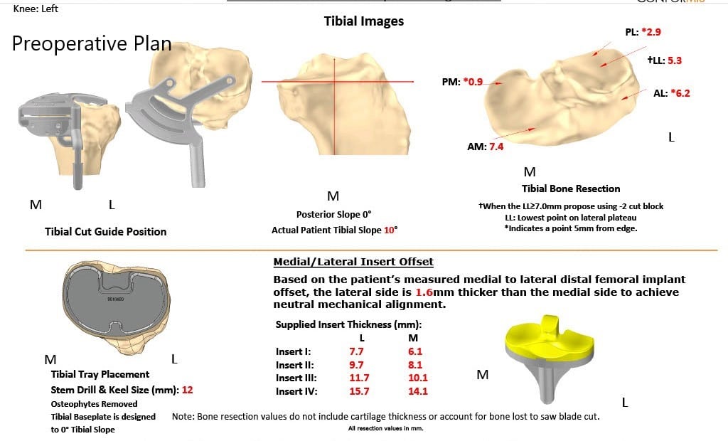 Complete Orthopedics patient specific surgical plan for a Left Custom Knee Replacement in a 67-year-old Female Complete Orthopedics patient specific surgical plan for a Left Custom Knee Replacement in a 67-year-old Female