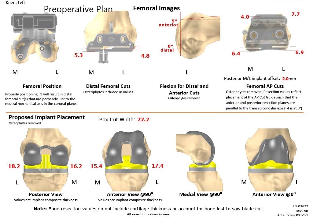 Complete Orthopedics patient specific surgical plan for a Left Custom Knee Replacement in a 67-year-old Female - scan 2 Complete Orthopedics patient specific surgical plan for a Left Custom Knee Replacement in a 67-year-old Female - scan 2