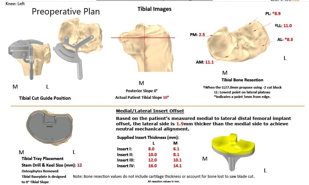 Complete Orthopedics patient specific surgical plan for a Left Custom Knee Replacement in a 70-year-old female Complete Orthopedics patient specific surgical plan for a Left Custom Knee Replacement in a 70-year-old female