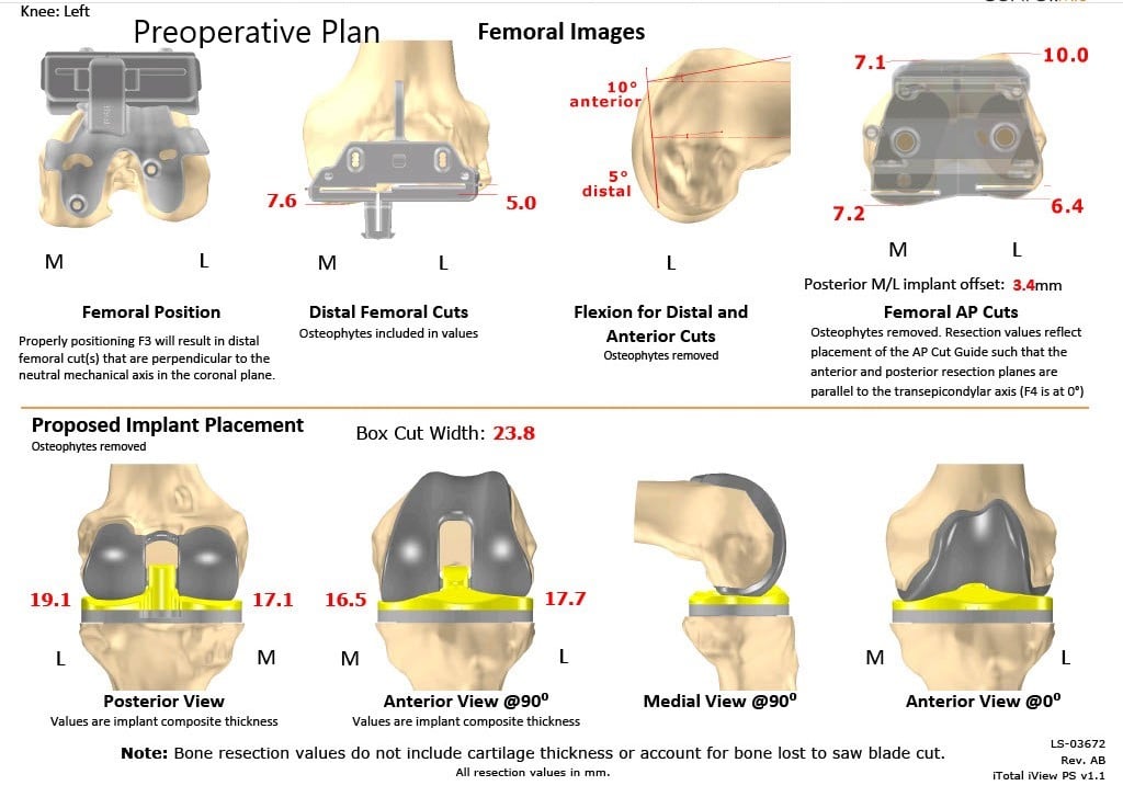 Complete Orthopedics patient specific surgical plan for a Left Custom Knee Replacement in a 70-year-old female - scan 2 Complete Orthopedics patient specific surgical plan for a Left Custom Knee Replacement in a 70-year-old female - scan 2