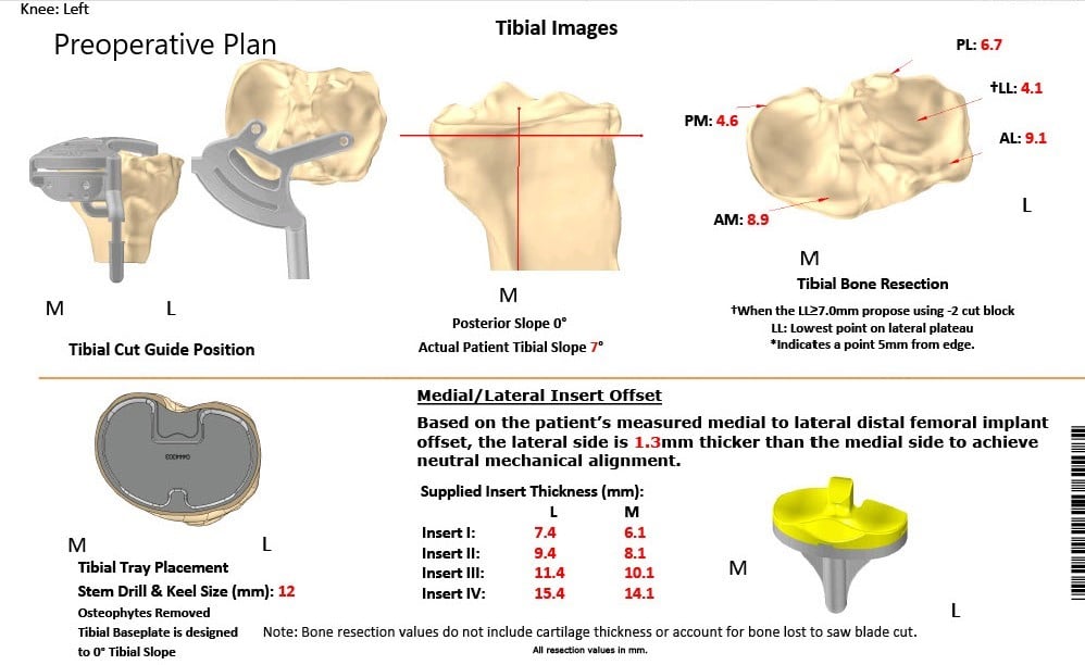 Complete Orthopedics patient specific surgical plan for a Bilateral Custom Total Knee Replacement in a 61-year-old male with Knee Arthritis & Genu Valgum Deformity Complete Orthopedics patient specific surgical plan for a Bilateral Custom Total Knee Replacement in a 61-year-old male with Knee Arthritis & Genu Valgum Deformity