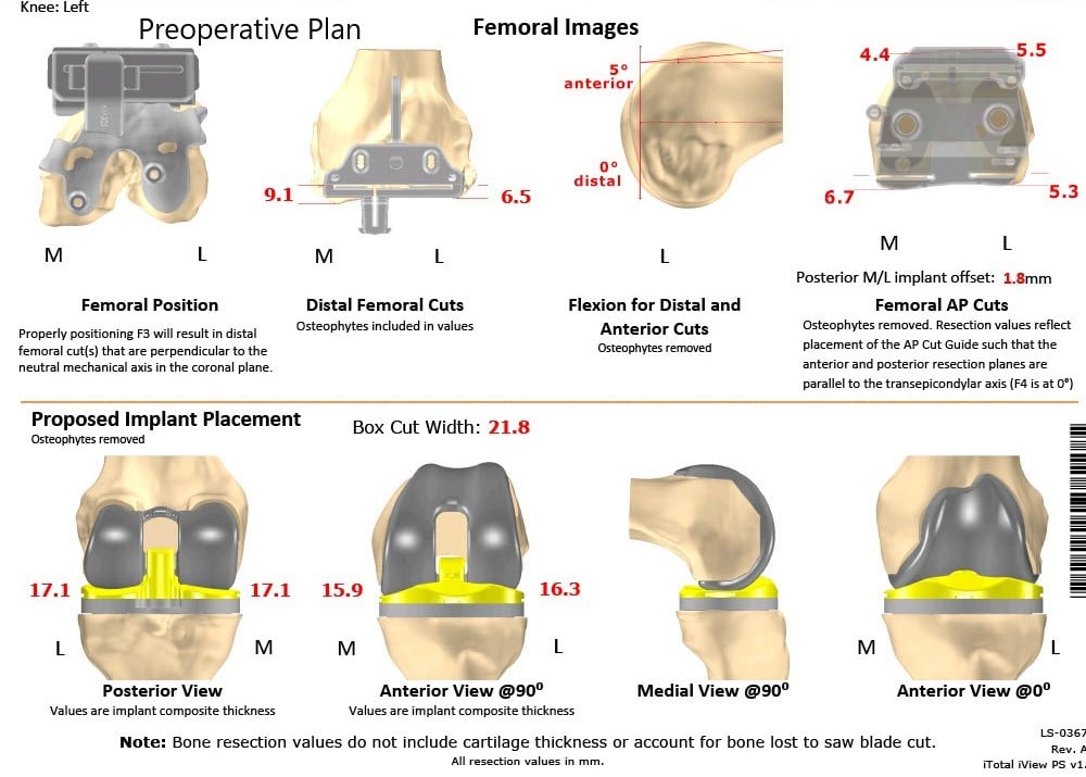 Complete Orthopedics patient specific surgical plan for a Bilateral Custom Total Knee Replacement in a 61-year-old male with Knee Arthritis & Genu Valgum Deformity - scan 2 Complete Orthopedics patient specific surgical plan for a Bilateral Custom Total Knee Replacement in a 61-year-old male with Knee Arthritis & Genu Valgum Deformity - scan 2