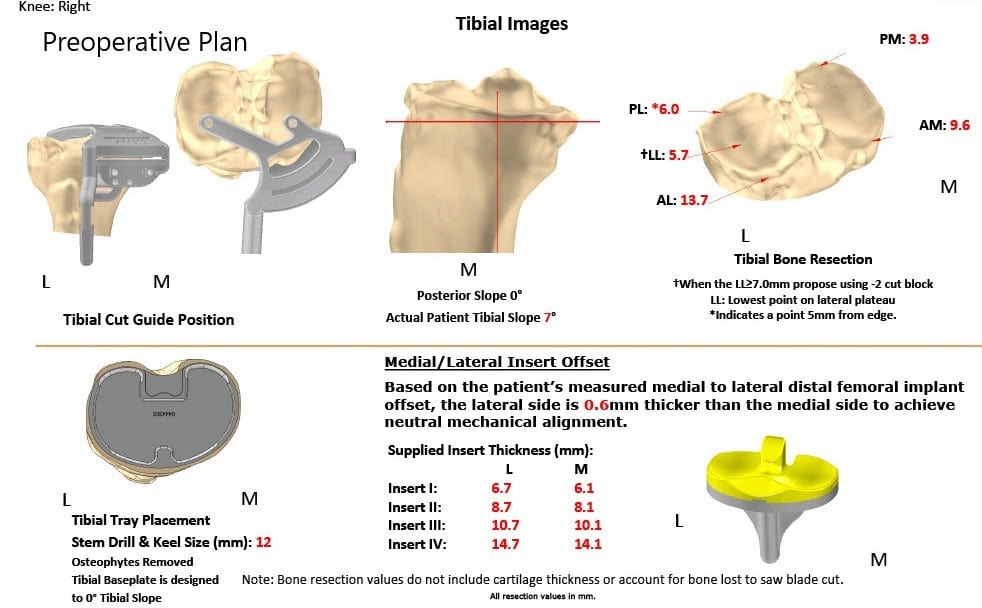 Complete Orthopedics patient specific surgical plan for a Bilateral Custom Total Knee Replacement in a 61-year-old male with Knee Arthritis & Genu Valgum Deformity - scan 3 Complete Orthopedics patient specific surgical plan for a Bilateral Custom Total Knee Replacement in a 61-year-old male with Knee Arthritis & Genu Valgum Deformity - scan 3