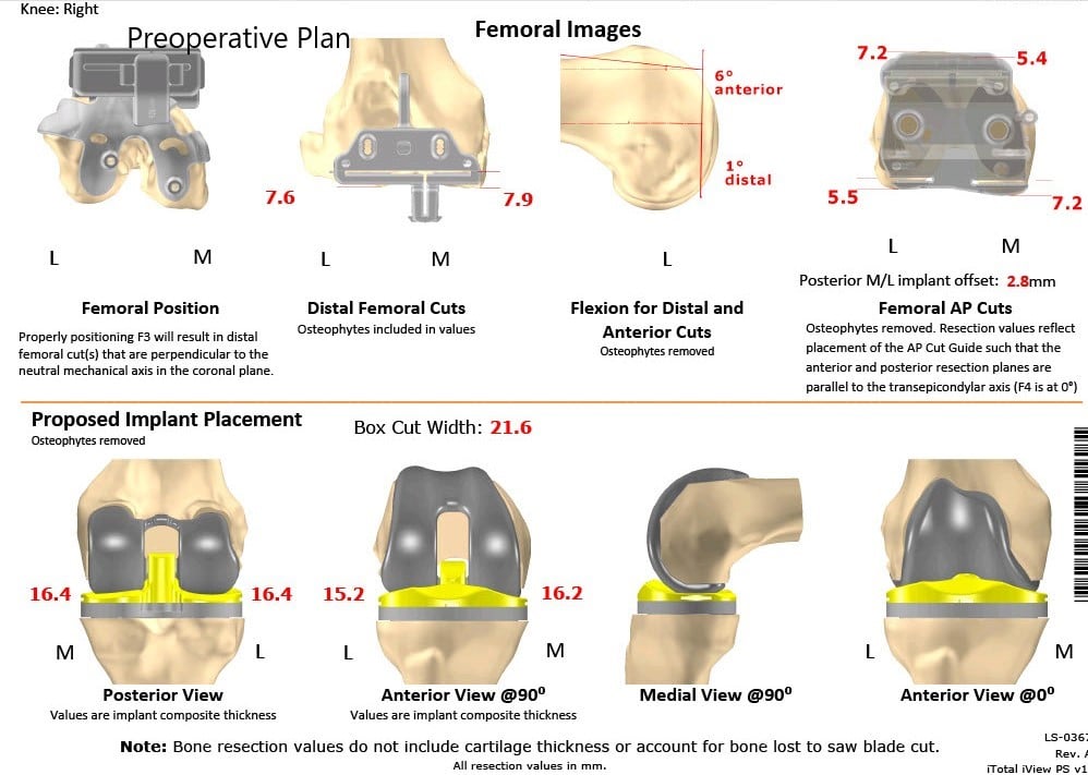 Complete Orthopedics patient specific surgical plan for a Bilateral Custom Total Knee Replacement in a 61-year-old male with Knee Arthritis & Genu Valgum Deformity - scan 4 Complete Orthopedics patient specific surgical plan for a Bilateral Custom Total Knee Replacement in a 61-year-old male with Knee Arthritis & Genu Valgum Deformity - scan 4