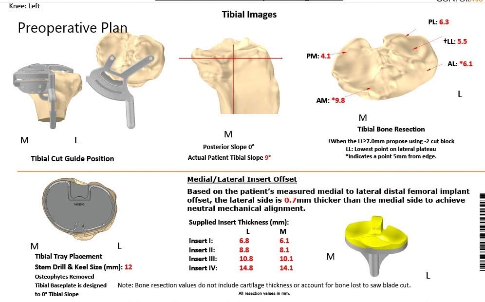 Complete Orthopedics patient specific surgical plan for a Bilateral Customized Total Knee Replacement in a 72-year-old female Complete Orthopedics patient specific surgical plan for a Bilateral Customized Total Knee Replacement in a 72-year-old female
