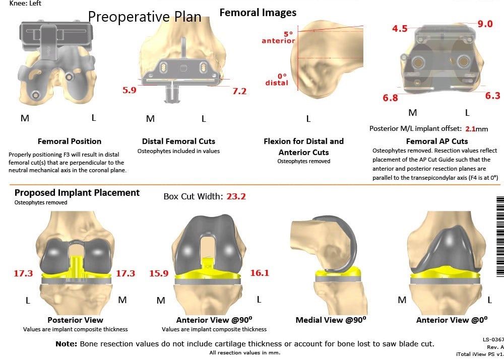 Complete Orthopedics patient specific surgical plan for a Bilateral Customized Total Knee Replacement in a 72-year-old female - scan 2 Complete Orthopedics patient specific surgical plan for a Bilateral Customized Total Knee Replacement in a 72-year-old female - scan 2