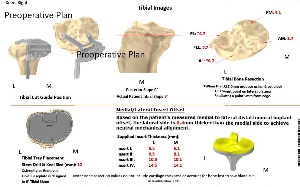 Complete Orthopedics patient specific surgical plan for a Bilateral Customized Total Knee Replacement in a 72-year-old female - scan 3 Complete Orthopedics patient specific surgical plan for a Bilateral Customized Total Knee Replacement in a 72-year-old female - scan 3