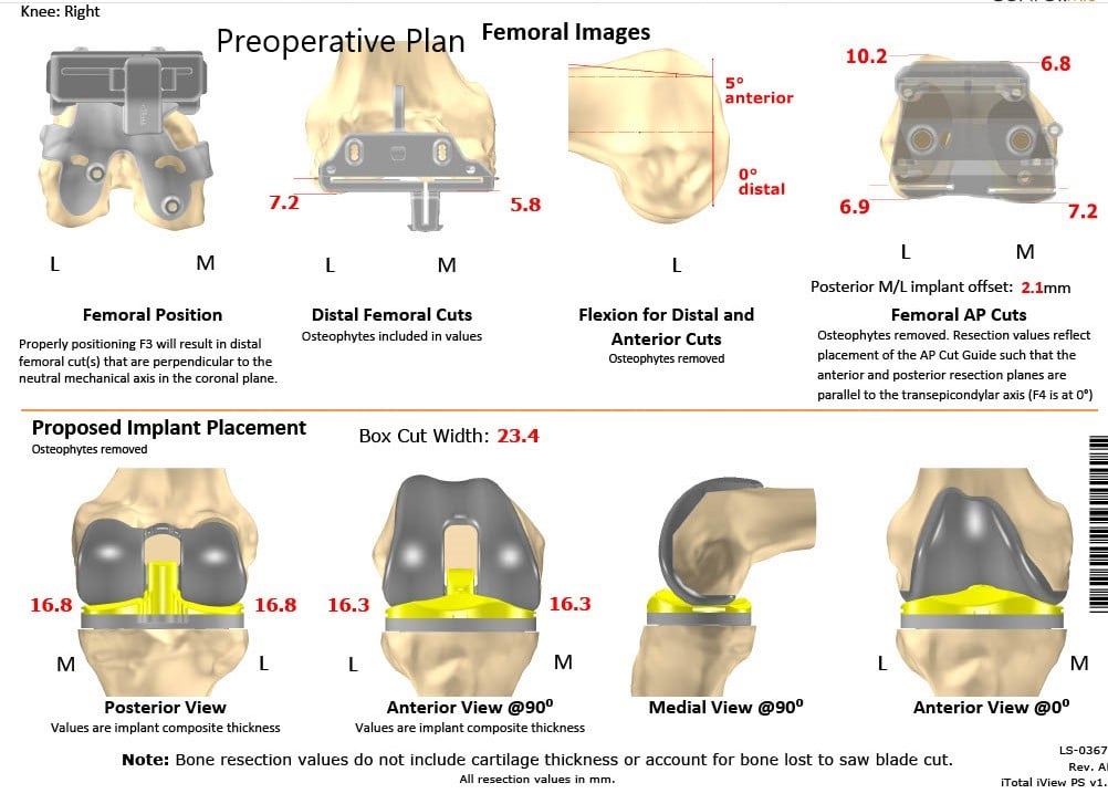 Complete Orthopedics patient specific surgical plan for a Bilateral Customized Total Knee Replacement in a 72-year-old female - scan 4 Complete Orthopedics patient specific surgical plan for a Bilateral Customized Total Knee Replacement in a 72-year-old female - scan 4