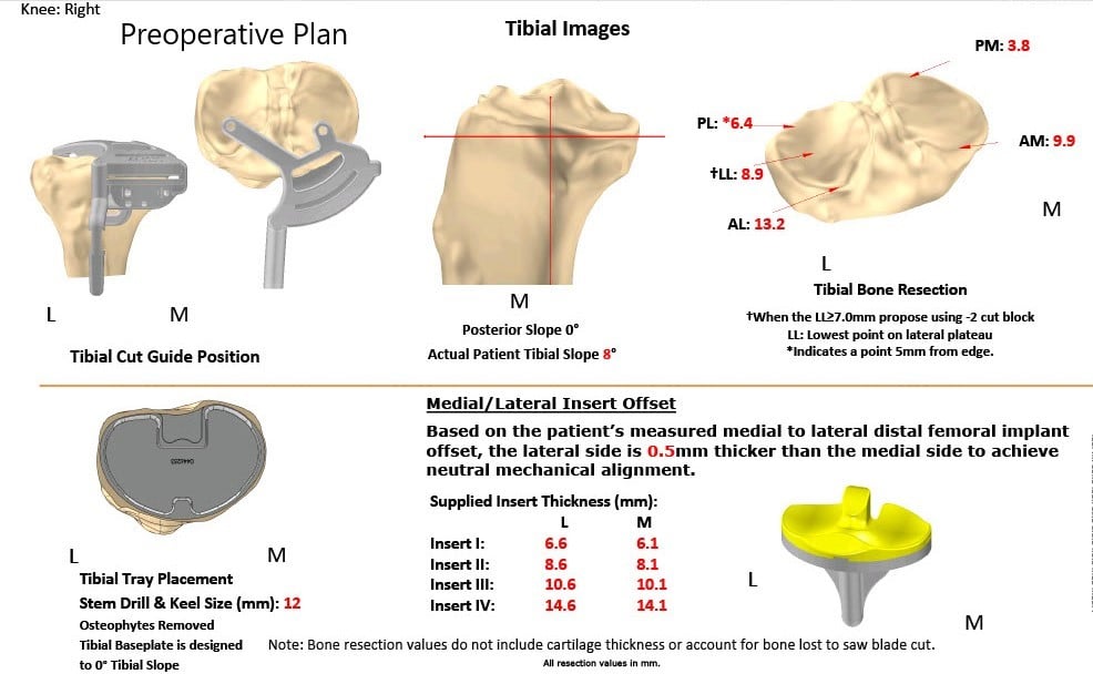 Complete Orthopedics patient specific surgical plan for a Bilateral Customized Total Knee Replacement in a 72-year-old patient with Arthritis Complete Orthopedics patient specific surgical plan for a Bilateral Customized Total Knee Replacement in a 72-year-old patient with Arthritis