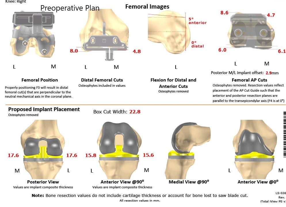 Complete Orthopedics patient specific surgical plan for a Bilateral Customized Total Knee Replacement in a 72-year-old patient with Arthritis - scan 2 Complete Orthopedics patient specific surgical plan for a Bilateral Customized Total Knee Replacement in a 72-year-old patient with Arthritis - scan 2