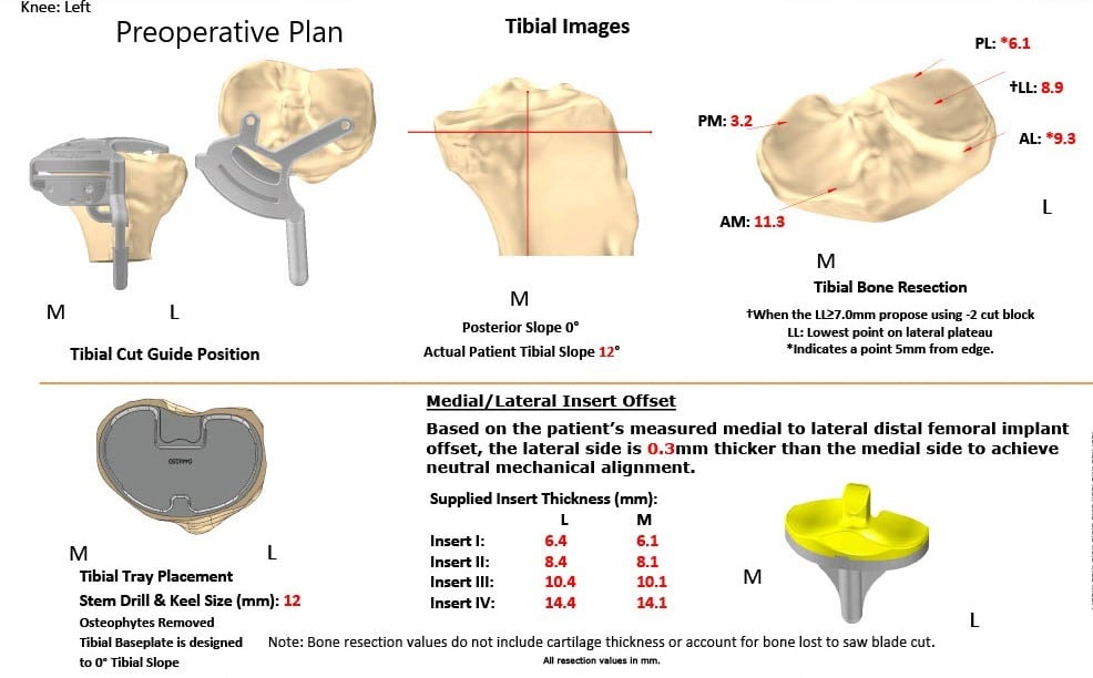 Complete Orthopedics patient specific surgical plan for a Bilateral Customized Total Knee Replacement in a 72-year-old patient with Arthritis - scan 3 Complete Orthopedics patient specific surgical plan for a Bilateral Customized Total Knee Replacement in a 72-year-old patient with Arthritis - scan 3