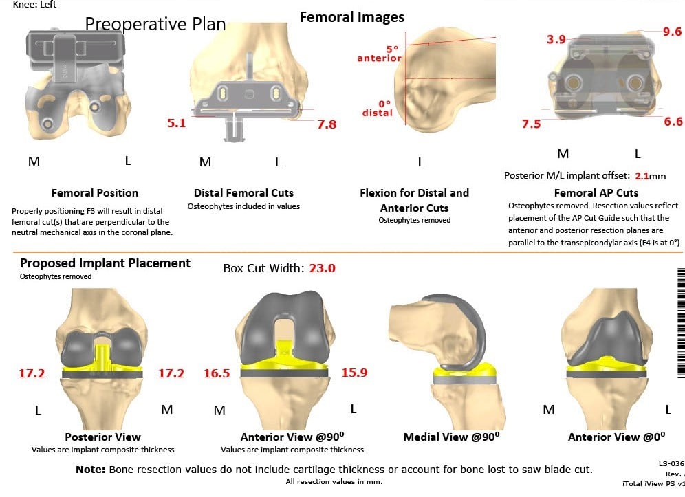 Complete Orthopedics patient specific surgical plan for a Bilateral Customized Total Knee Replacement in a 72-year-old patient with Arthritis - scan 4 Complete Orthopedics patient specific surgical plan for a Bilateral Customized Total Knee Replacement in a 72-year-old patient with Arthritis - scan 4