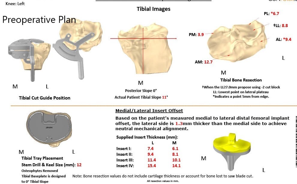Complete Orthopedics patient specific surgical plan for a Custom Left Knee Replacement in a 71-year-old male Complete Orthopedics patient specific surgical plan for a Custom Left Knee Replacement in a 71-year-old male